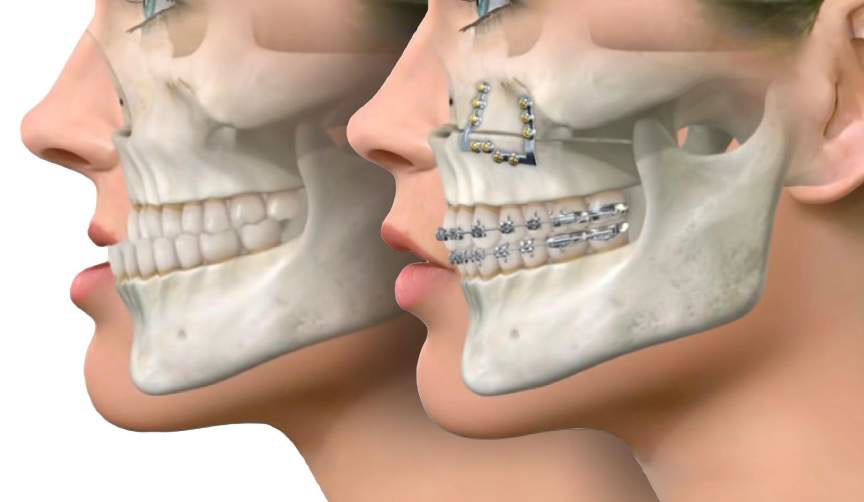 Bite Correction Surgery